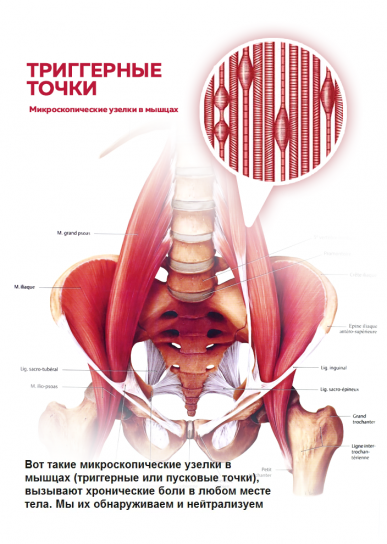 Триггерные точки